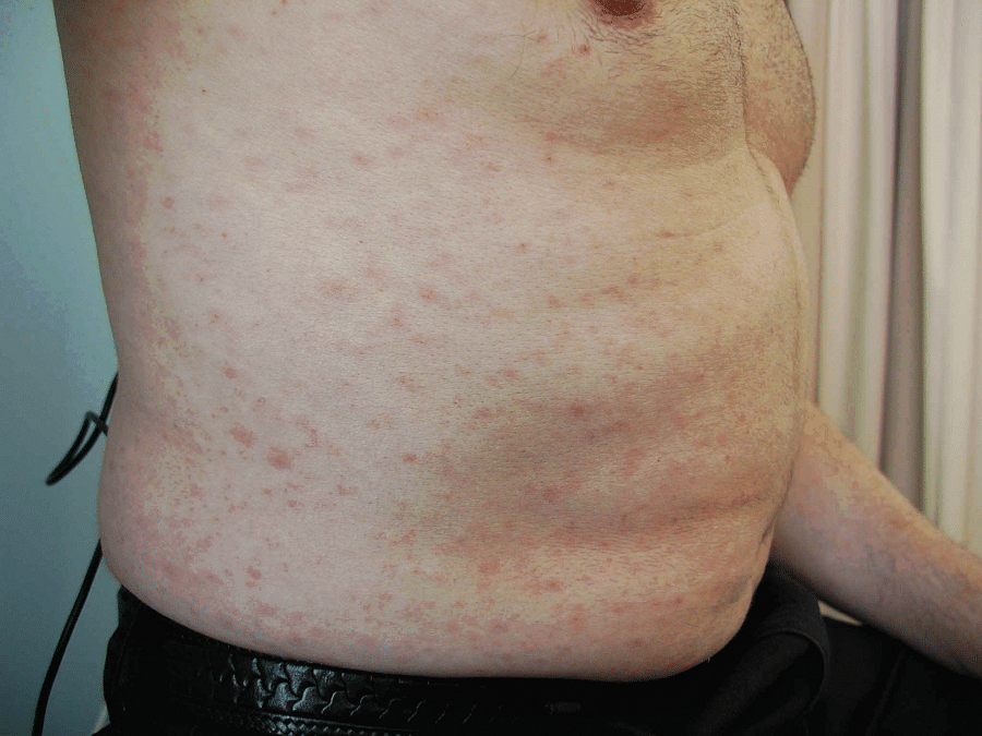 maculopapular rash